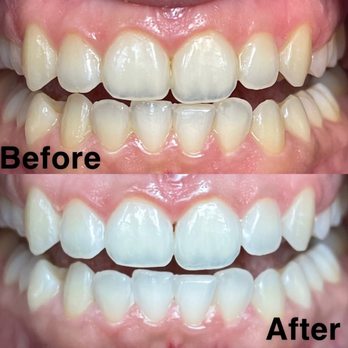 Brighter Smiles - Before and After results - Teeth Whitening Near Me Brighter Smiles - Before and After results - Teeth Whitening Near Me
