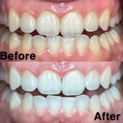 Brighter Smiles - Before and After results