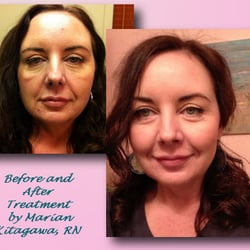 Marian, Aesthetic Nurse Specialist - Client photo: Before and After several visits
