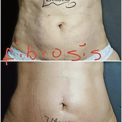 La Massage by Design - FOR MORE INFO VISIT LAMASSAGEBYDESIGN.COM OR CALL (954) 736-9035 the difference between post surgical massage after a lipo and not doing the