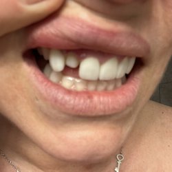 Modern Smile Center - The teeth before... too big, wouldn't stay on and teeth filed too much.