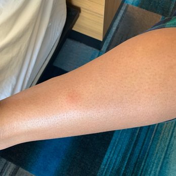 Aloft by Marriott Broomfield Denver - Bed bug bites on my daughter. Told a day AFTER check in that no turn down service for 5 days. They re-used the same sheets on day 5 - Hotels Near Me - Broomfield, Colorado Aloft by Marriott Broomfield Denver - Bed bug bites on my daughter. Told a day AFTER check in that no turn down service for 5 days. They re-used the same sheets on day 5 - Hotels Near Me - Broomfield, Colorado