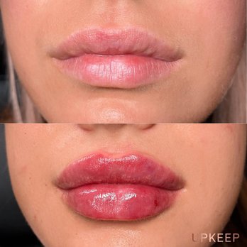 UPKEEP - LIP FILLER - Medical Spas Near Me - New York, New York