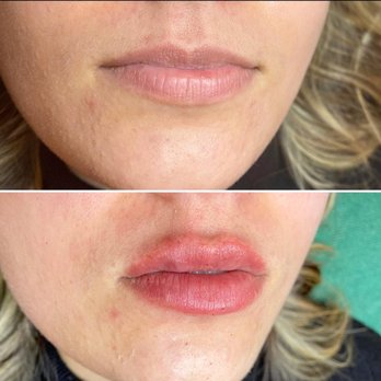 Triumphant Light - Hyaluronic acid lip filler using the HYA-PEN - Skin Care Near Me - The Dalles, Oregon