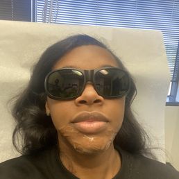 Laser Hair Removal to the chin Laser Hair Removal to the chin