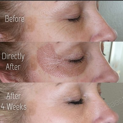 Lower Eyelid + Crow's Feet Treatment - My client came to me wanting to improve the appearance of her deep crows feet wrinkles and under eyes. Combo eye treatments are a great way to tackle multiple areas, all at one appointment!
I saw instant tightening of the skin, You can see the crows feet are greatly reduced, and her under eye is smooth and rejuvenated.
⚡Treatment: Under Eyes + crows feet
⚡Treatment time: 1-1.5 hours including numbing time
⚡Downtime: 5-7 days for crusts to fall off
⚡Results last : 1-3 years Lower Eyelid + Crow's Feet Treatment - My client came to me wanting to improve the appearance of her deep crows feet wrinkles and under eyes. Combo eye treatments are a great way to tackle multiple areas, all at one appointment!
I saw instant tightening of the skin, You can see the crows feet are greatly reduced, and her under eye is smooth and rejuvenated.
⚡Treatment: Under Eyes + crows feet
⚡Treatment time: 1-1.5 hours including numbing time
⚡Downtime: 5-7 days for crusts to fall off
⚡Results last : 1-3 years