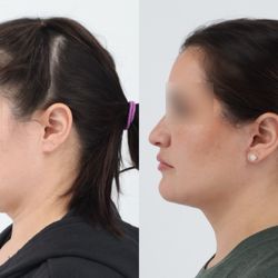 Madnani Facial Plastics - 42 yo 4 months after Face, Neck lift, erbium laser around eyes by Dr. Chouake.