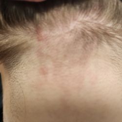 Hair Studio One - Blisters on my daughter's neck Amy French left as a result of hair color.