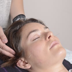 Acupuncture by Candice - Acupuncture for allergies