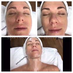 Spa Zoey Skin Care - Dermalogica:BioActive Peel-Before, After & De-Celerator.