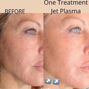 Robin's Day Spa - Jet Plasma - Skin Care Near Me - Tampa, Florida Robin's Day Spa - Jet Plasma - Skin Care Near Me - Tampa, Florida