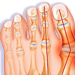 Richard L Lizerbram, DPM - Bunions: Most often found on the inner foot near the big toe. Bunions are a painful yet common condition caused by inflammation of the bursa