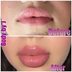 Body by J - Lip filler