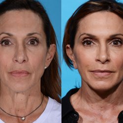 Jay Burns, MD - Lower facelift - Before & After