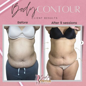 The Body Contour Spa - Body Contouring Near Me - Vancouver, British Columbia The Body Contour Spa - Body Contouring Near Me - Vancouver, British Columbia