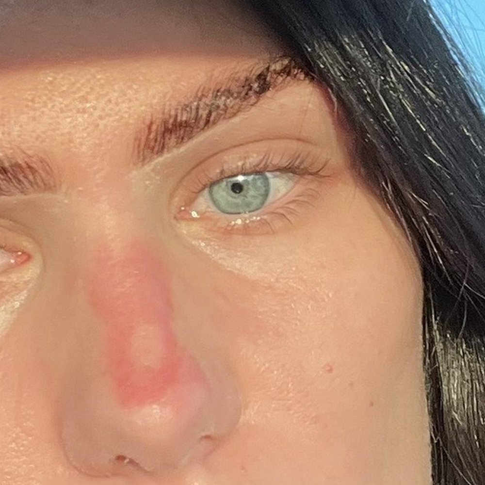 The Lash Lounge - burns from treatment, poorly done brows - Makeup Artists Near Me - Modesto, California The Lash Lounge - burns from treatment, poorly done brows - Makeup Artists Near Me - Modesto, California