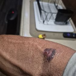 BioLife Plasma Services - Needle jabbed through arm here