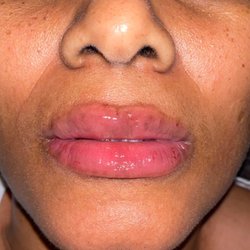 Attrayant Beauté Studio - Procedure: Natural Lip (1ML)
