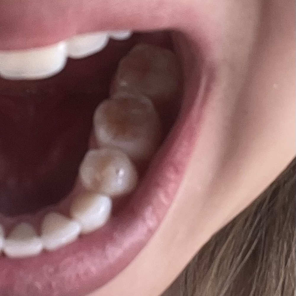 Normandy Lake Dentistry - Normandy Jacksonville - Filling done on second back molar by Dr. Lee. - Orthodontists Near Me - Jacksonville, Florida