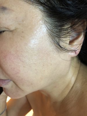 Results - Whether it's redness, acne, dehydration, wrinkles or any other skincare concerns, K Skin has got you covered. Check out some of the before and after of skincare concern results. Call now to book your appointment today. Results - Whether it's redness, acne, dehydration, wrinkles or any other skincare concerns, K Skin has got you covered. Check out some of the before and after of skincare concern results. Call now to book your appointment today.