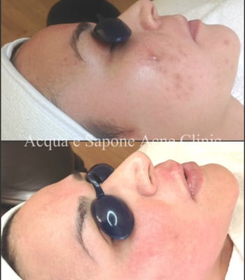 AES Acne Clinic by null