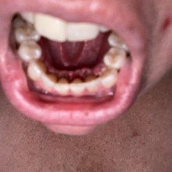 AMOS Associates In Maxillofacial & Oral Surgery - Tori removal- stitches came out left me with my gums detached from my teeth
