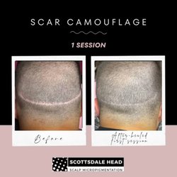 Scottsdale Head - Scar camo healed one session. 2 more sessions required for seamless blending