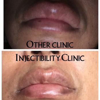 InjectAbility Clinic - Lip filler comparison - Skin Care Near Me - Torrance, California InjectAbility Clinic - Lip filler comparison - Skin Care Near Me - Torrance, California
