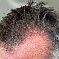 Bosley Hair Restoration & Transplant - They keep deleting my post so I'll keep posting it to expose the truth! Run from Dr Cohen!!!!!