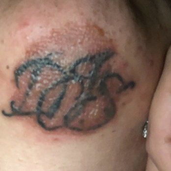 Neoderma - Burns from Laser Tattoo Removal Treatment - Medical Spas Near Me - Anaheim, California