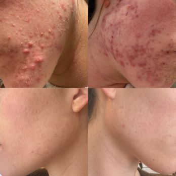 North County Skin Solutions - Acne Treatment Near Me - Encinitas, California North County Skin Solutions - Acne Treatment Near Me - Encinitas, California