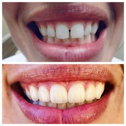 Platinum Smiles Family Dentistry - Gap closure with all ceramic crowns!