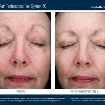 Define Beauty Medspa - Alpharet Peel - Medical Spas Near Me - Phoenix, Arizona Define Beauty Medspa - Alpharet Peel - Medical Spas Near Me - Phoenix, Arizona