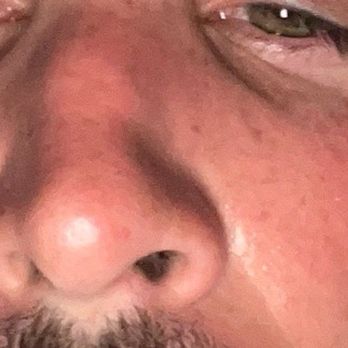 David A. Bray, Jr., M.D - Before - Cosmetic Surgeons Near Me - Torrance, California