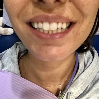 Fillmore Dental Spa - After Shaving Closed - General Dentistry Near Me - San Francisco, California