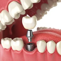 Red Square Dental & Orthodontics - Dental implants dentist orthodontics mcallen dentist edinburg dentist