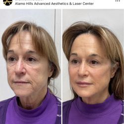 Alamo Hills Advanced Aesthetics and Laser Center - Actual Alamo Hills patient.  Non-surgical facelift with a combination of dermal fillers and neurotoxin