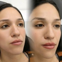 Luminance Aesthetics - A beautiful before and after of a lip augmentation.