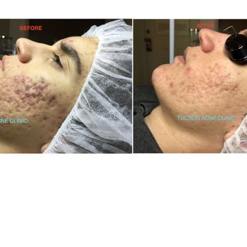 Tucson Acne Clinic - Skin Care Near Me - Tucson, Arizona Tucson Acne Clinic - Skin Care Near Me - Tucson, Arizona