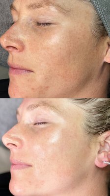 Dermaplaning - Dermaplaning is one of our most popular treatments! This treatment uses a blade in a shaving motion to remove fine facial hair commonly known as “peach fuzz” and gently exfoliates the outer layer of dead skin cells leaving the skin soft and smooth.
Dermaplaning enhances product penetration, facilitates an extremely smooth surface, and glowing skin.
Book Online or Text Today! Dermaplaning - Dermaplaning is one of our most popular treatments! This treatment uses a blade in a shaving motion to remove fine facial hair commonly known as “peach fuzz” and gently exfoliates the outer layer of dead skin cells leaving the skin soft and smooth.
Dermaplaning enhances product penetration, facilitates an extremely smooth surface, and glowing skin.
Book Online or Text Today!