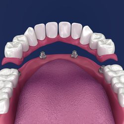 Keele Crosstown Dental - Dentures in York