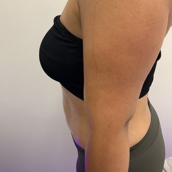Tialli Bellá - 3rd session - Body Contouring Near Me - Alexandria, Virginia Tialli Bellá - 3rd session - Body Contouring Near Me - Alexandria, Virginia