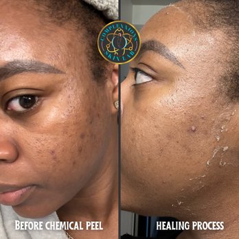 Complexxions Skin Lab - Dark spots fading during a chemical peel healing process. This peel lasted about 6.5 days. - Waxing Near Me - Houston, Texas Complexxions Skin Lab - Dark spots fading during a chemical peel healing process. This peel lasted about 6.5 days. - Waxing Near Me - Houston, Texas