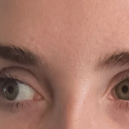 Fully healed, 2 months post touchup apt Fully healed, 2 months post touchup apt