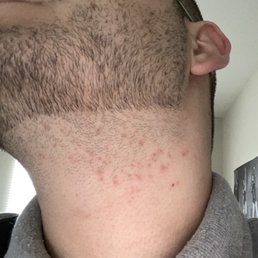 Just two days later and I'm left with bumps all over my neck. I shave every three to four days and this never happens. Just two days later and I'm left with bumps all over my neck. I shave every three to four days and this never happens.