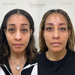 Facial Balancing | Elegance Aesthetics Med Spa