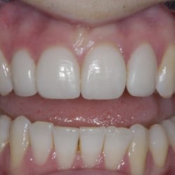 Ambridge Ceramics Dental Laboratory - HFO Veneers