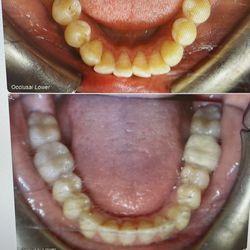 Xmile Orthodontics - Teeth before and after (bottom)