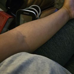 Labcorp - Bruising (inner arm)