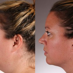 Joseph M Hadi, MD - FaceTite Facial Rejuvenation